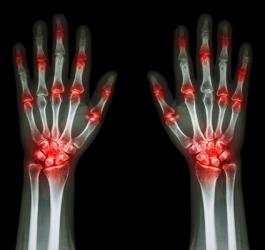RTG dłoni z widocznymi stanami zapalnymi stawów. typowymi dla reumatoidalnego zapalenia stawów.
