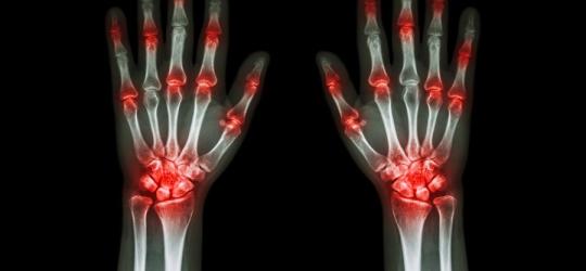 RTG dłoni z widocznymi stanami zapalnymi stawów. typowymi dla reumatoidalnego zapalenia stawów.
