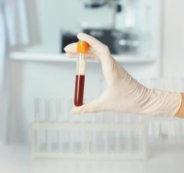 Diagnosta trzyma w ręce fiolkę z próbką krwi pacjenta.