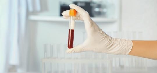 Diagnosta trzyma w ręce fiolkę z próbką krwi pacjenta.