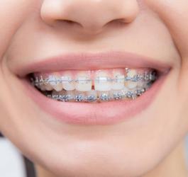 Zbliżenie na kobiecy uśmiech. Na zębach jest widoczny aparat ortodontyczny.