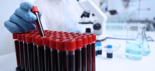 Diagnosta wyciąga fiolkę krwi do badania apolipoproteiny B.