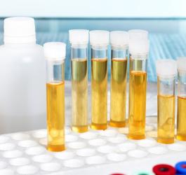 Fiolki z próbkami moczu do analizy m.in. na obecność azotynów w moczu.