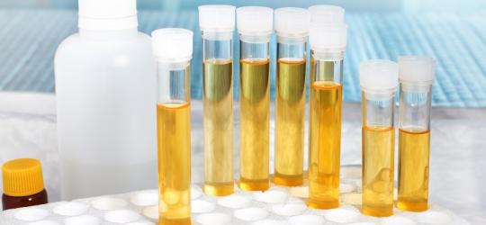 Fiolki z próbkami moczu do analizy m.in. na obecność azotynów w moczu.