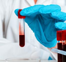 Diagnosta trzyma w ręce próbkę krwi pacjenta, przeznaczoną do badania PSA.