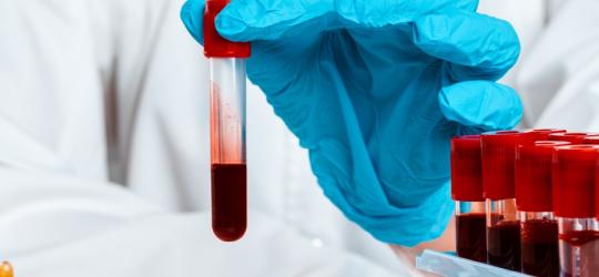 Diagnosta trzyma w ręce próbkę krwi pacjenta, przeznaczoną do badania PSA.