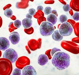 Elementy morfotyczne krwi w przebiegu białaczki.