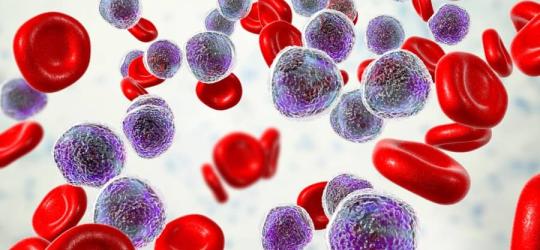 Elementy morfotyczne krwi w przebiegu białaczki.