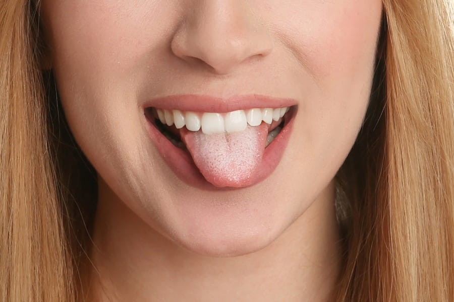Kobieta pokazuje język z widocznym białym nalotem.