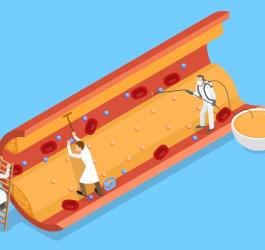 Rysunkowi lekarze próbujący usunąć blaszkę miażdżycową z naczynia krwionośnego.