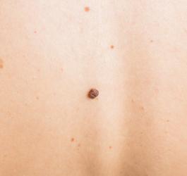 Brodawka łojotokowa widoczna na skórze pleców.