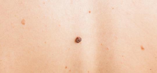 Brodawka łojotokowa widoczna na skórze pleców.