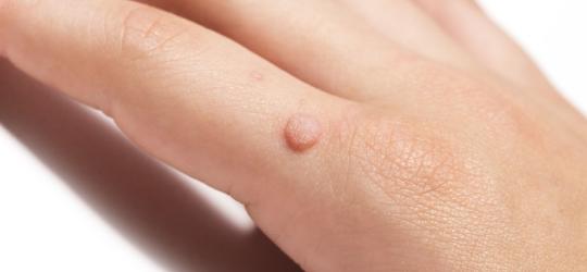 Zbliżenie na dłoń z widoczną brodawką.