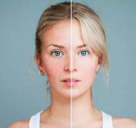 Zdjęcie twarzy kobiety, podzielone. Po lewej stronie cera podrażniona, po prawej zdrowa.