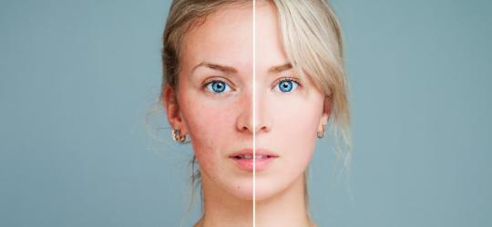 Zdjęcie twarzy kobiety, podzielone. Po lewej stronie cera podrażniona, po prawej zdrowa.