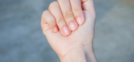 Zbliżenie na dłoń z widoczną chorobą paznokci.