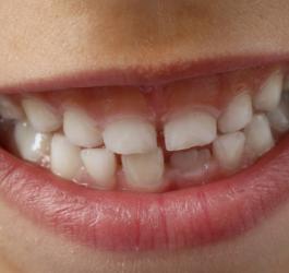 Czy warto leczyć zęby mleczne?