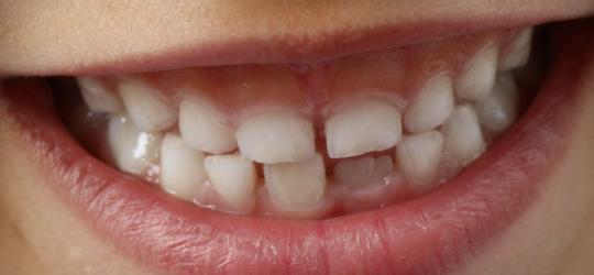 Czy warto leczyć zęby mleczne?