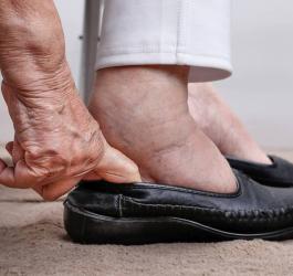 Czym jest stopa cukrzycowa?