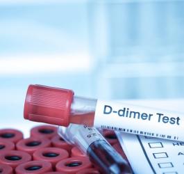 Fiolka krwi pacjenta przeznaczona do badania stężenia d-dimerów.