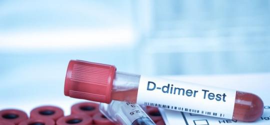 Fiolka krwi pacjenta przeznaczona do badania stężenia d-dimerów.