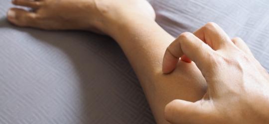 Kobieta drapie się po łydce, cierpi na dermatofitozę.