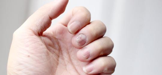 Zbliżenie na dłoń z widoczną drożdżycą paznokci na środkowym palcu.