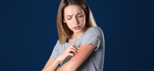 Kobieta drapie się po ręce. Swędzi ją skóra, bo cierpi na erytrodermię.