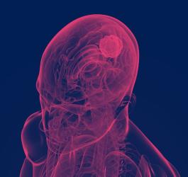 Koncept głowy z widocznym mózgiem oraz rozwijającym się glejakiem.