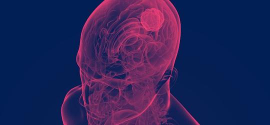 Koncept głowy z widocznym mózgiem oraz rozwijającym się glejakiem.