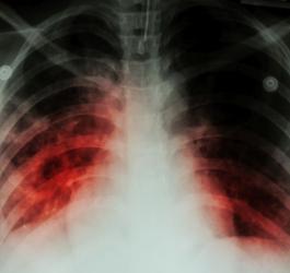 gruźlica klatka piersowa