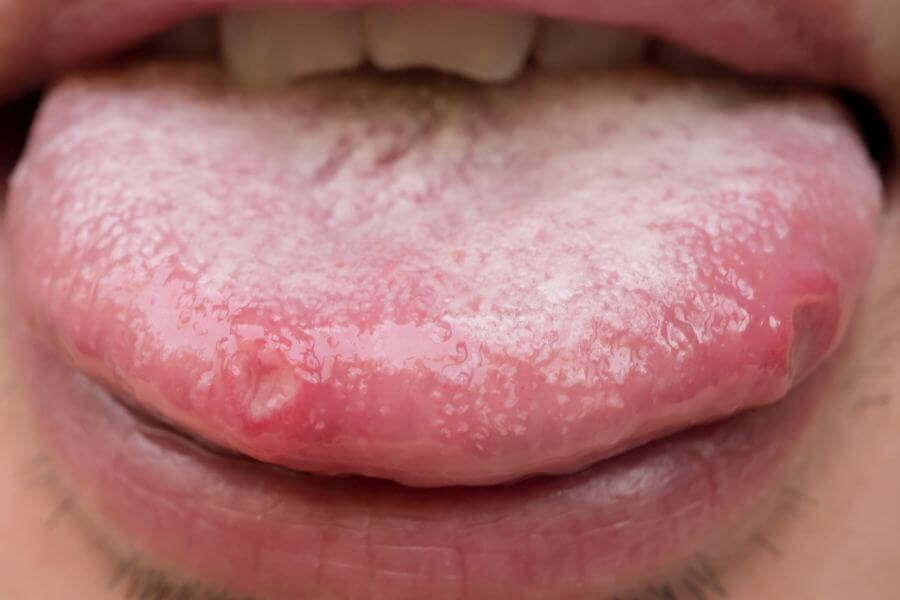 grzybica jamy ustnej
