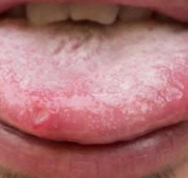 grzybica jamy ustnej