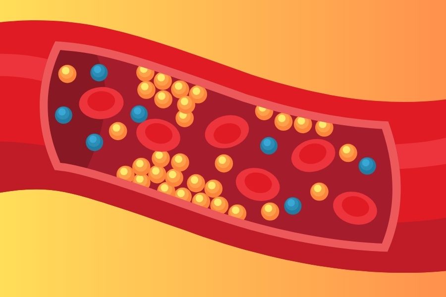 Wysoki poziom cholesterolu w naczyniu krwionośnym.