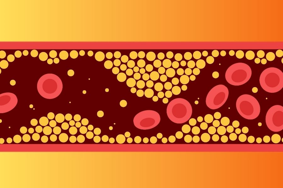 Rysunkowe naczynie krwionośne obrazujące hipercholesterolemię.