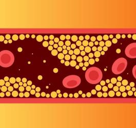 Rysunkowe naczynie krwionośne obrazujące hipercholesterolemię.