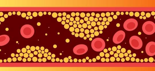 Rysunkowe naczynie krwionośne obrazujące hipercholesterolemię.