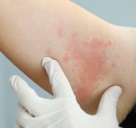 Widoczna na skórze pacjenta wysypka alergiczna, spowodowana działaniem histaminy.