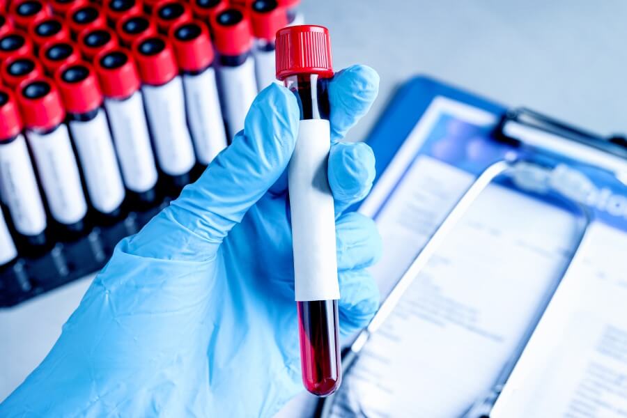 Diagnosta trzyma dłoni fiolkę z krwią pacjenta do badania stężenia lutropiny.