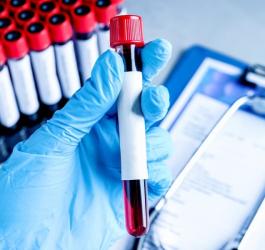 Diagnosta trzyma dłoni fiolkę z krwią pacjenta do badania stężenia lutropiny.