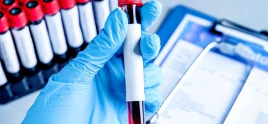 Diagnosta trzyma dłoni fiolkę z krwią pacjenta do badania stężenia lutropiny.