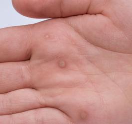 hpv