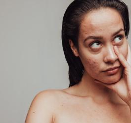 Kobieta z widocznymi zmianami trądzikowymi na twarzy.