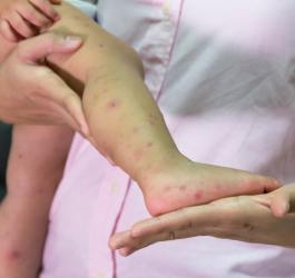 Jak leczyć bostonkę?