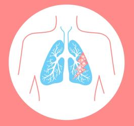Jak rozpoznać zapalenie płuc?