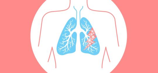 Jak rozpoznać zapalenie płuc?
