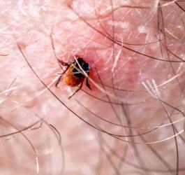 Kleszcz wbity w skórę człowieka.