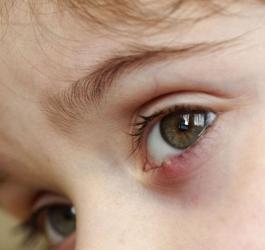 jęczmień pod okiem