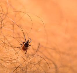 Kleszcz na skórze człowieka. Jego ukąszenie może doprowadzić do rozwoju kleszczowego zapalenia mózgu