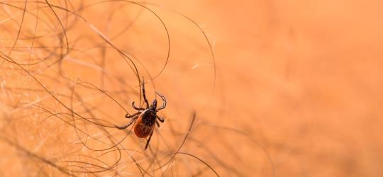 Kleszcz na skórze człowieka. Jego ukąszenie może doprowadzić do rozwoju kleszczowego zapalenia mózgu